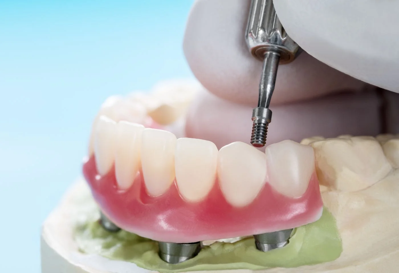 Prótesis fija completa sobre implantes dentales