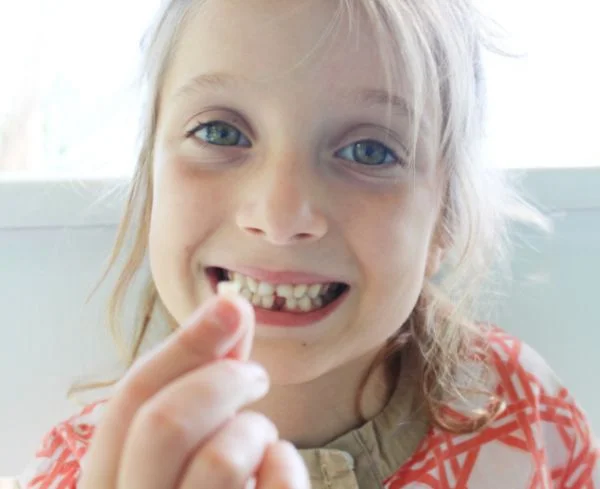 Niña mostrando un diente de leche caído tras un traumatismo dental en la clínica Multiestetik