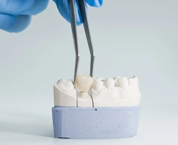 Coronas dentales estéticas para restaurar la forma y apariencia de los dientes