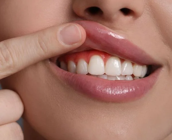 Tratamiento de estética de encías para mejorar la armonía entre dientes y encías