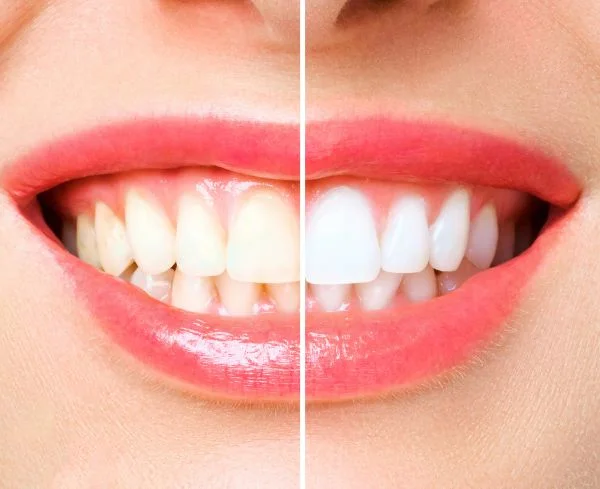 Resultado antes y después de un blanqueamiento dental para aclarar el color de los dientes